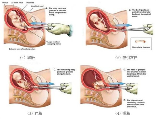 最伤子宫的6件事，想怀孕就少做！