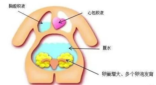 卵巢过度刺激综合症是什么原因导致的？如何降低卵巢过度刺激综合的发生？