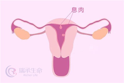 宫颈息肉是什么？是否会对试管婴儿的进程和结果产生影响呢？