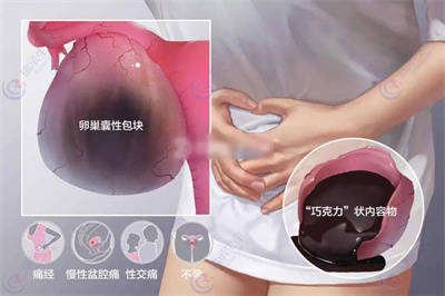 卵巢囊肿，做试管婴儿还能取出可用的卵子吗？