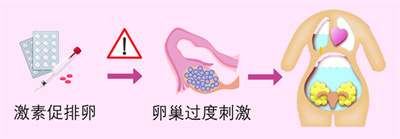 做试管婴儿怎么避免卵巢过度刺激综合征？