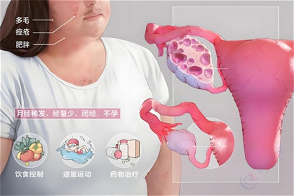 患有多囊卵巢综合征，做试管婴儿能否取到优质卵子？