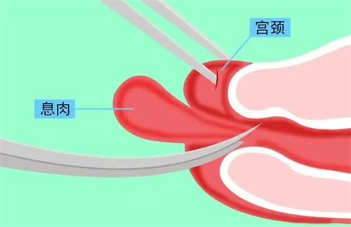 有宫颈息肉会影响试管婴儿周期吗？