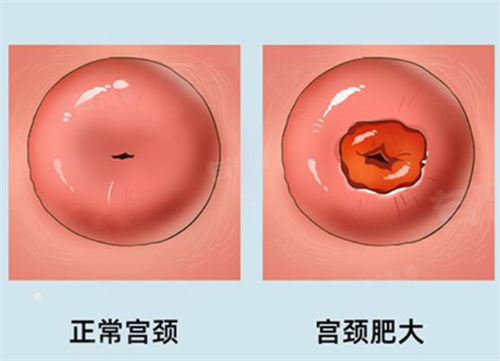 宫颈肥大会影响试管婴儿囊胚移植吗？