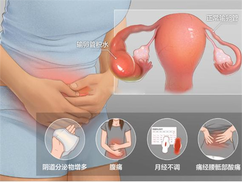 输卵管积水：藏在“生命通道”里的隐患，如何影响试管成功率？数据揭示真相