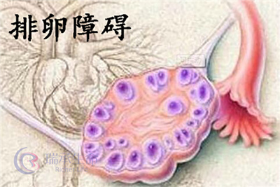 排卵障碍如何通过科学方案顺利跨越生育障碍