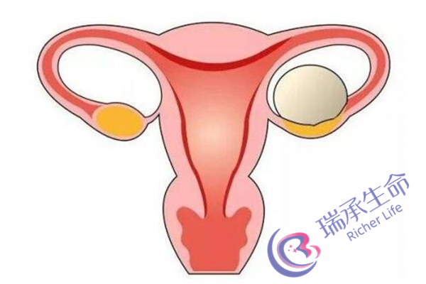 B超能检查出多囊卵巢吗？多囊卵巢可以通过B超来检查吗？
