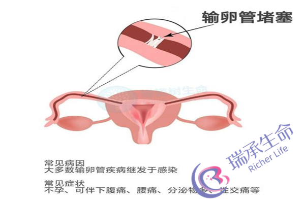 女生有输卵管性不孕会影响试管婴儿吗  造成女性输卵管性不孕的病因有哪些呢
