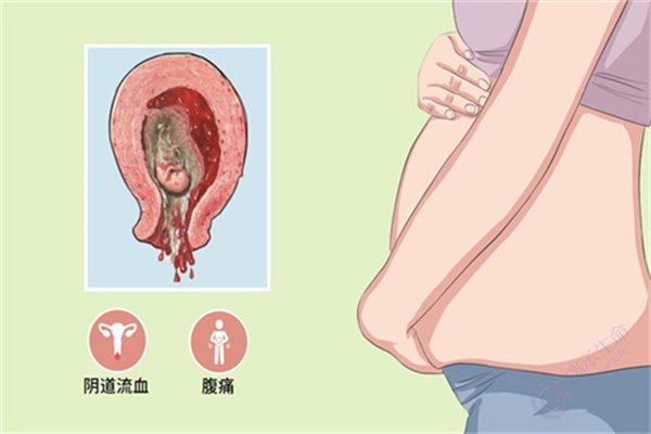 有自然流产史的家庭，是否建议选择第三代试管婴儿？