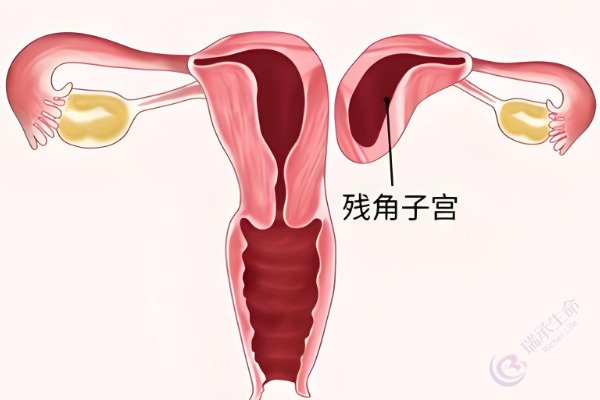 残角子宫女性试管求子：多管齐下保障活产率