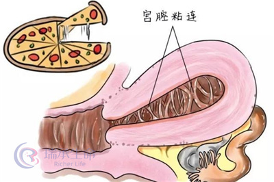 宫腔粘连可以做试管婴儿吗?试管之路的“隐形障碍”与“突破策略”