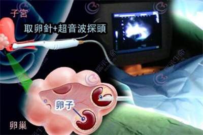 黄体功能不足怎么办？做试管婴儿能成功吗？