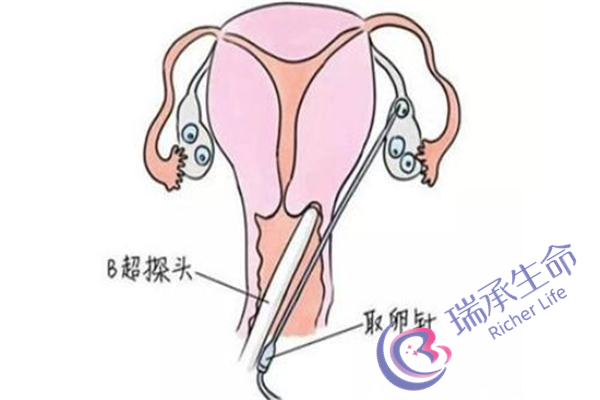 子宫内膜异位症吃什么药能治好？子宫内膜异位症有哪些药可选择？