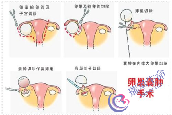 多囊卵巢会导致胎停吗？该怎样预防和应对呢？
