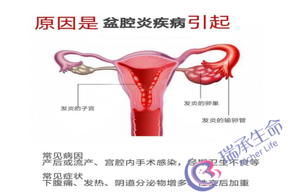 多囊卵巢用什么药最好？如何选择适合自己的药物？